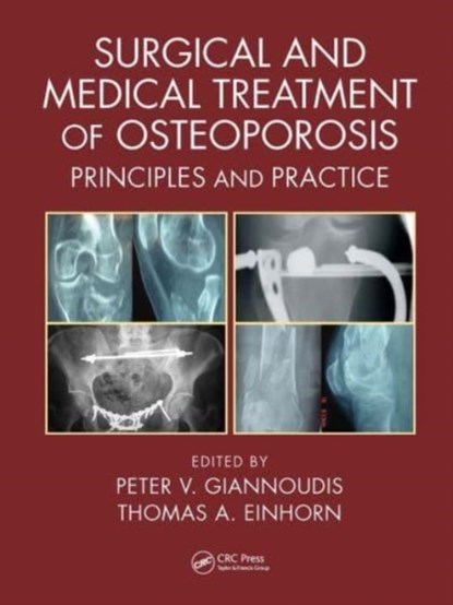 Surgical and Medical Treatment of Osteoporosis, Peter V. Giannoudis ; Thomas A. Einhorn - Paperback - 9781032569765