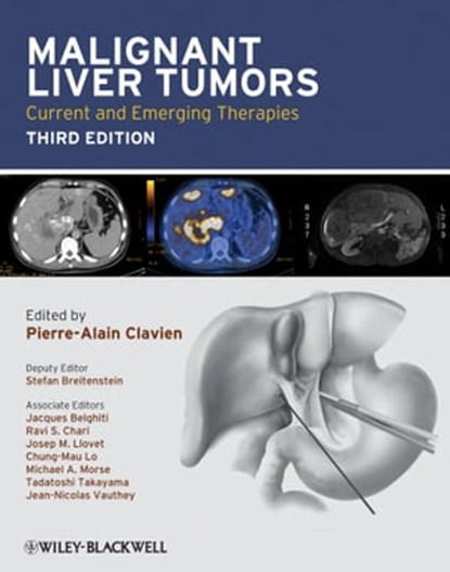 Malignant Liver Tumors, Stefan Breitenstein ; Jacques Belghiti ; Ravi S. Chari ; Josep M. Llovet ; Chung-Mau Lo ; Michael A. Morse ; Tadatoshi Takayama ; Jean-Nicolas Vauthey - Ebook - 9781444356397