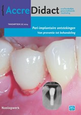 Peri-implantaire ontstekingen - Yvonne de Waal ; Gordon van der Avoort ; Erik Blom ; Jarno Hakkers - 9789089765420