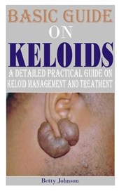 Basic Guide on Keloids