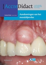 Aandoeningen van het mondslijmvlies - Isaac van der Waal - 9789089761224