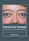 Thyroid Eye Disease: Understanding Graves' Ophthalmopathy - Edgar Harrison - 9781646465491