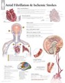 Atrial Fib & Ischemic Strokes Paper Poster -  - 9781935612322