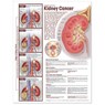 Understanding Kidney Cancer Anatomical Chart -  - 9780781786515