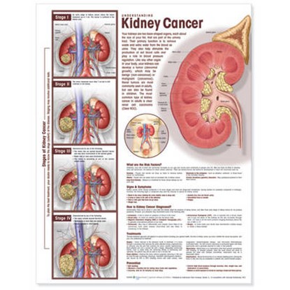 Understanding Kidney Cancer Anatomical Chart, niet bekend - Overig - 9780781786515