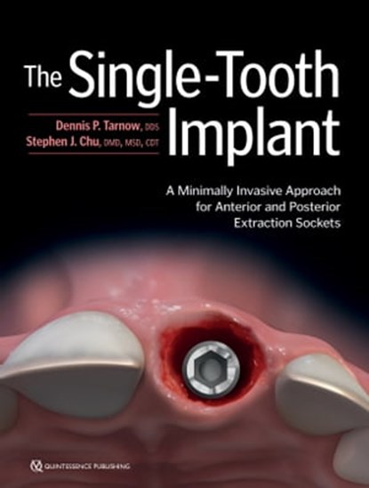 The Single-Tooth Implant:, Dennis P. Tarnow ; Stephen J. Chu - Ebook - 9780867159738