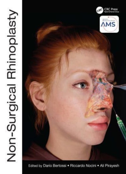 Non-Surgical Rhinoplasty, Dario (Associate Professor in Maxillo Facial Surgery Bertossi ; Riccardo Nocini ; Ali Pirayesh - Gebonden - 9781032303444