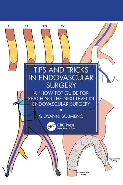 Tips and Tricks in Endovascular Surgery, Giovanni Solimeno - Paperback - 9781032936710