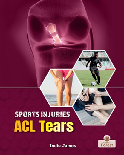ACL Tears, India James - Gebonden - 9781039880795
