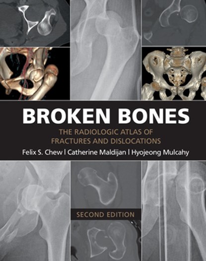 Broken Bones, Felix S. (University of Washington) Chew ; Catherine (University of Pittsburgh) Maldijan ; Hyojeong (University of Washington) Mulcahy - Paperback - 9781107499232