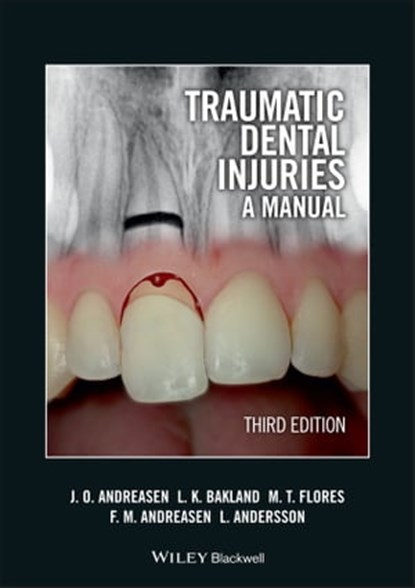 Traumatic Dental Injuries, Jens O. Andreasen ; Leif K. Bakland ; Maria Teresa Flores ; Frances M. Andreasen ; Lars Andersson - Ebook - 9781118250150