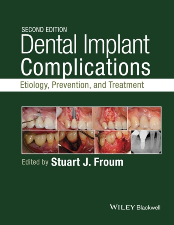 Dental Implant Complications - Etiology, , and Treatment, Second Edition