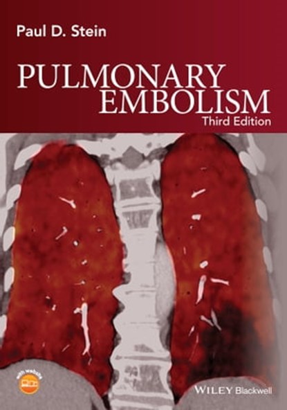 Pulmonary Embolism, Paul D. Stein - Ebook - 9781119039105