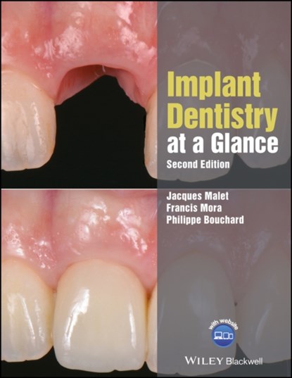 Implant Dentistry at a Glance, Jacques ( Assistant Professor of Clinical Dentistry Malet ; Francis ( Associate Professor Mora ; Philippe ( Professor Bouchard - Paperback - 9781119292609