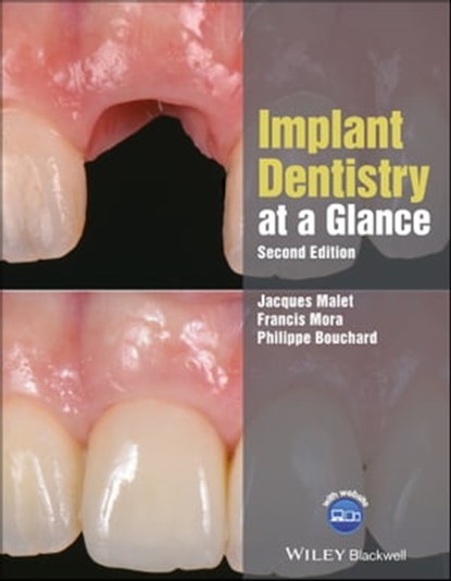 Implant Dentistry at a Glance, Jacques Malet ; Francis Mora ; Philippe Bouchard - Ebook - 9781119292630