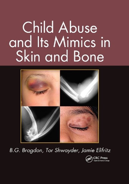 Child Abuse and its Mimics in Skin and Bone, B. G. Brogdon ; Tor Shwayder ; Jamie Elifritz - Gebonden - 9781439855355