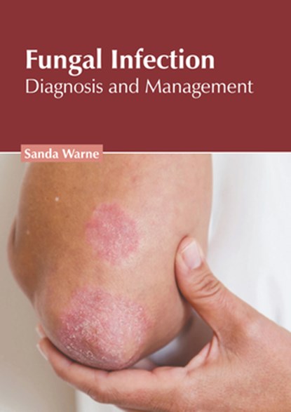 Fungal Infection: Diagnosis and Management, Sanda Warne - Gebonden - 9781639276721