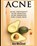 Acne, MCCLOUD,  Ace - Paperback - 9781640480018