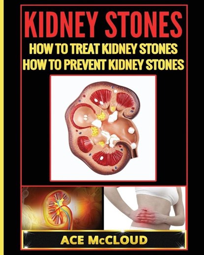 Kidney Stones, Ace McCloud - Paperback - 9781640480469
