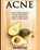 Acne, Ace McCloud - Paperback - 9781640481268