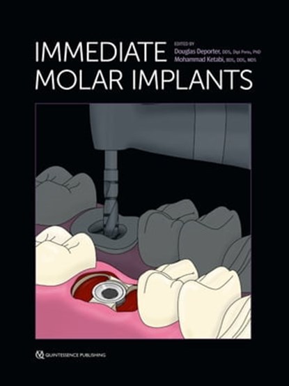 Immediate Molar Implants, Douglas Deporter ; Mohammad Ketabi - Ebook - 9781647241636