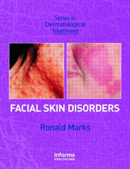 Facial Skin Disorders, Ronald Marks - Gebonden - 9781841842103