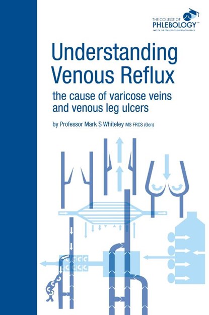 Understanding Venous Reflux the Cause of Varicose Veins and Venous Leg Ulcers, Mark S. Whiteley - Paperback - 9781908586001