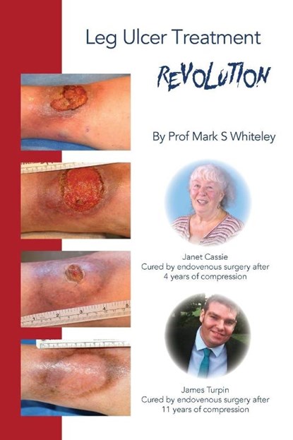 Leg Ulcer Treatment Revolution, Mark Whiteley - Paperback - 9781908586056