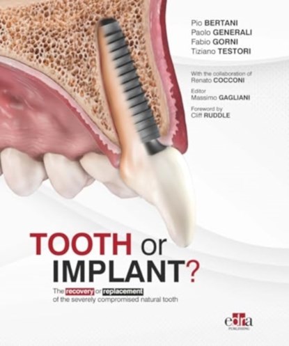 Tooth or Implant, Paolo Generali ; Fabio Gorni ; Tiziano Testori - Gebonden - 9781957260525