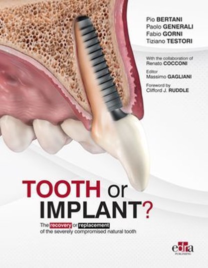 Tooth or Implant?, Pio Bertani ; Paolo Generali ; Fabio Gorni ; Tiziano Testori ; Renato Cocconi ; Clifford J. Ruddle - Ebook - 9781957260709