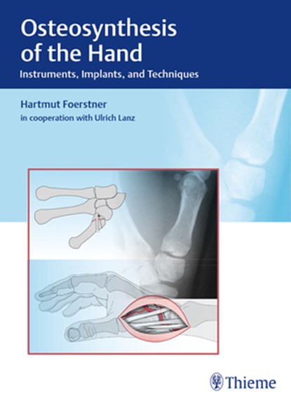 Osteosynthesis of the Hand, Hartmut Forstner - Gebonden - 9783132038110
