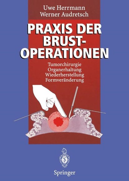 Praxis Der Brustoperationen, Uwe Herrmann ; Werner Audretsch - Paperback - 9783642796098