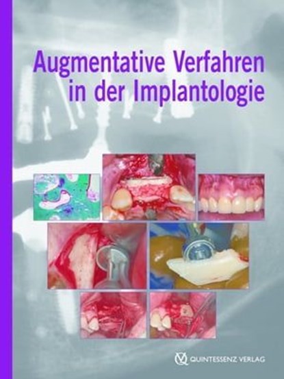 Augmentative Verfahren in der Implantologie, Fouad Khoury - Ebook - 9783868670240