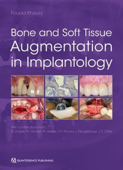 Bone and Soft Tissue Augmentation in Implantology, niet bekend - Ebook - 9783868675917