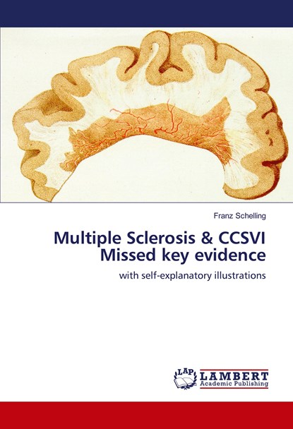 Multiple Sclerosis & CCSVI Missed key evidence, Franz Schelling - Paperback - 9786139920563