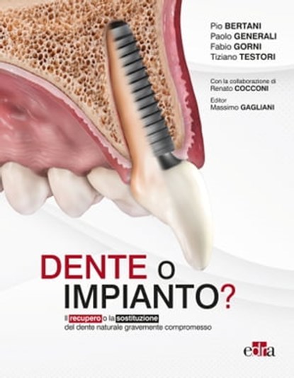 Dente o impianto?, Pio Bertani ; Paolo Generali ; Fabio Gorni ; Tiziano Testori - Ebook - 9788821454332