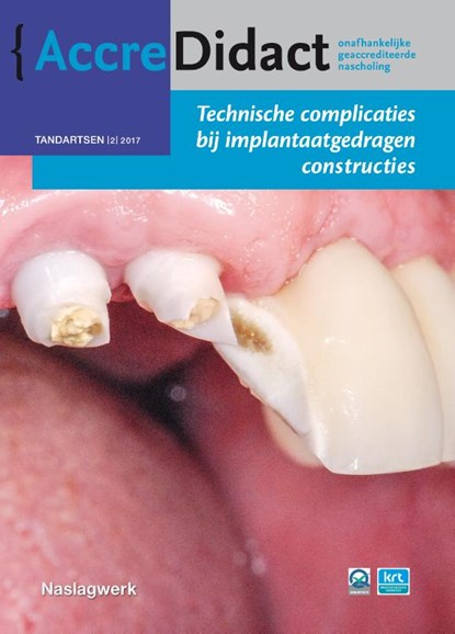 Technische complicaties bij implantaatgedragen constructies, Gordon van der Avoort - Paperback - 9789089762498