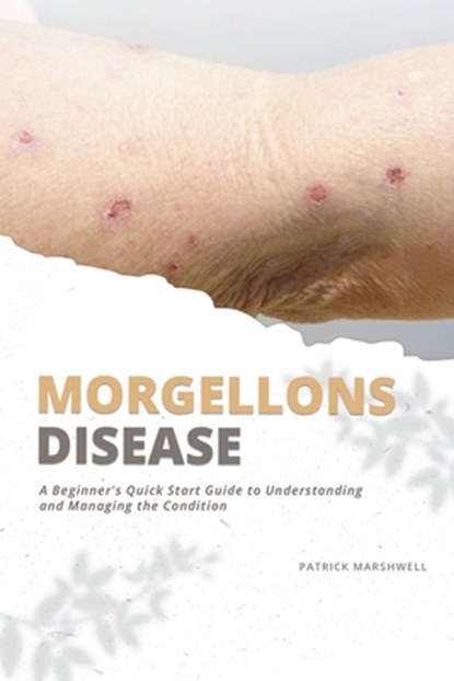 Morgellons Disease: A Beginner's Quick Start Guide to Understanding and Managing the Condition, Patrick Marshwell - Paperback - 9798348158545