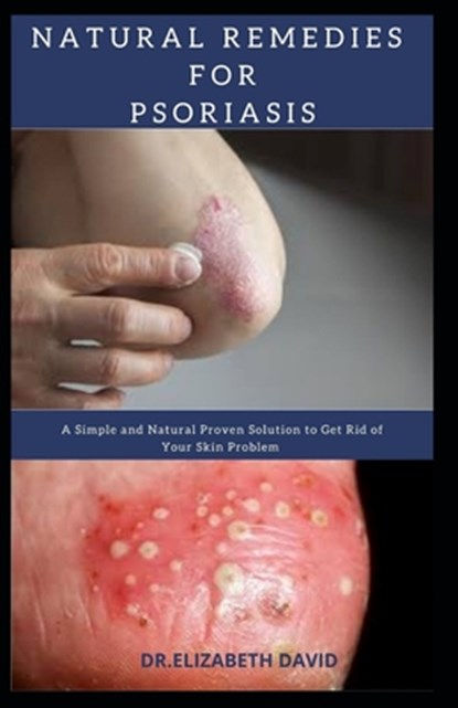 Natural Remedies for Psoriasis: A Simple and Natural Proven Solution to Get Rid of Your Skin Problem: Dermatitis, Eczema, Psoriasis & Rosacea and Othe, Elizabeth David - Paperback - 9798637692934