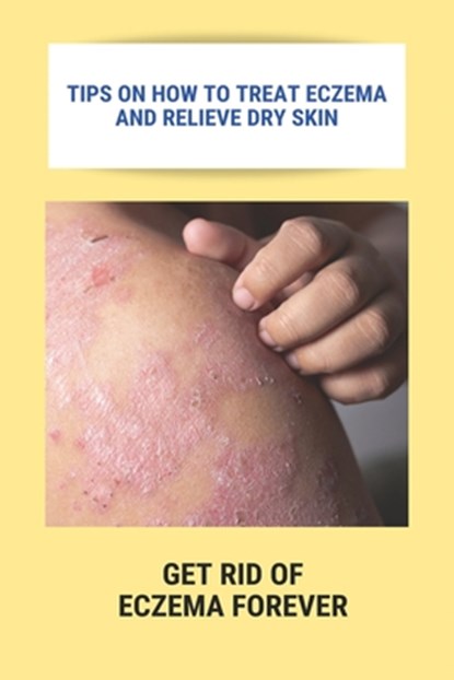 Tips On How To Treat Eczema And Relieve Dry Skin: Get Rid Of Eczema Forever: Overcome Eczema, Courtney Apkin - Paperback - 9798740518794