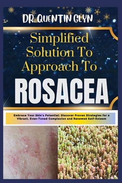 Simplified Solution Approach To ROSACEA: Embrace Your Skin's Potential: Discover Proven Strategies for a Vibrant, Even-Toned Complexion and Renewed Se, Quentin Glyn - Paperback - 9798876709585