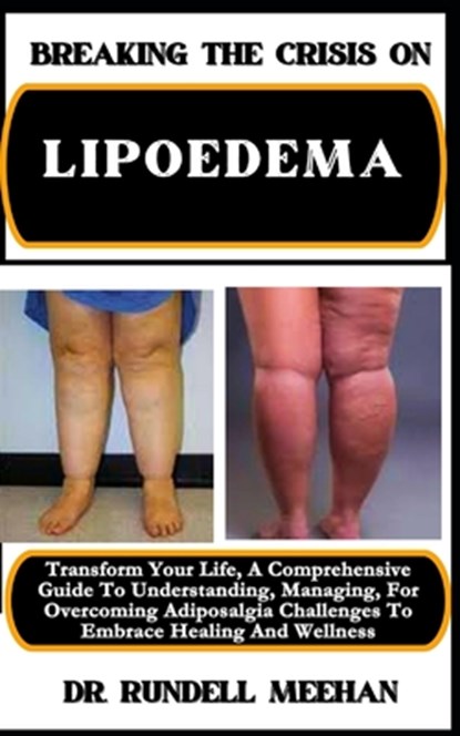 Breaking the Crisis on Lipoedema: Transform Your Life, A Comprehensive Guide To Understanding, Managing, For Overcoming Adiposalgia Challenges To Embr, Rundell Meehan - Paperback - 9798883348579