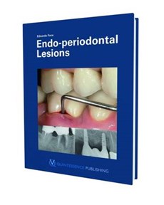 Endo-Periodontal Lesions