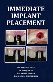 Immediate Implant Placement
