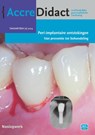 Peri-implantaire ontstekingen - Yvonne de Waal ; Gordon van der Avoort ; Erik Blom ; Jarno Hakkers - 9789089765420